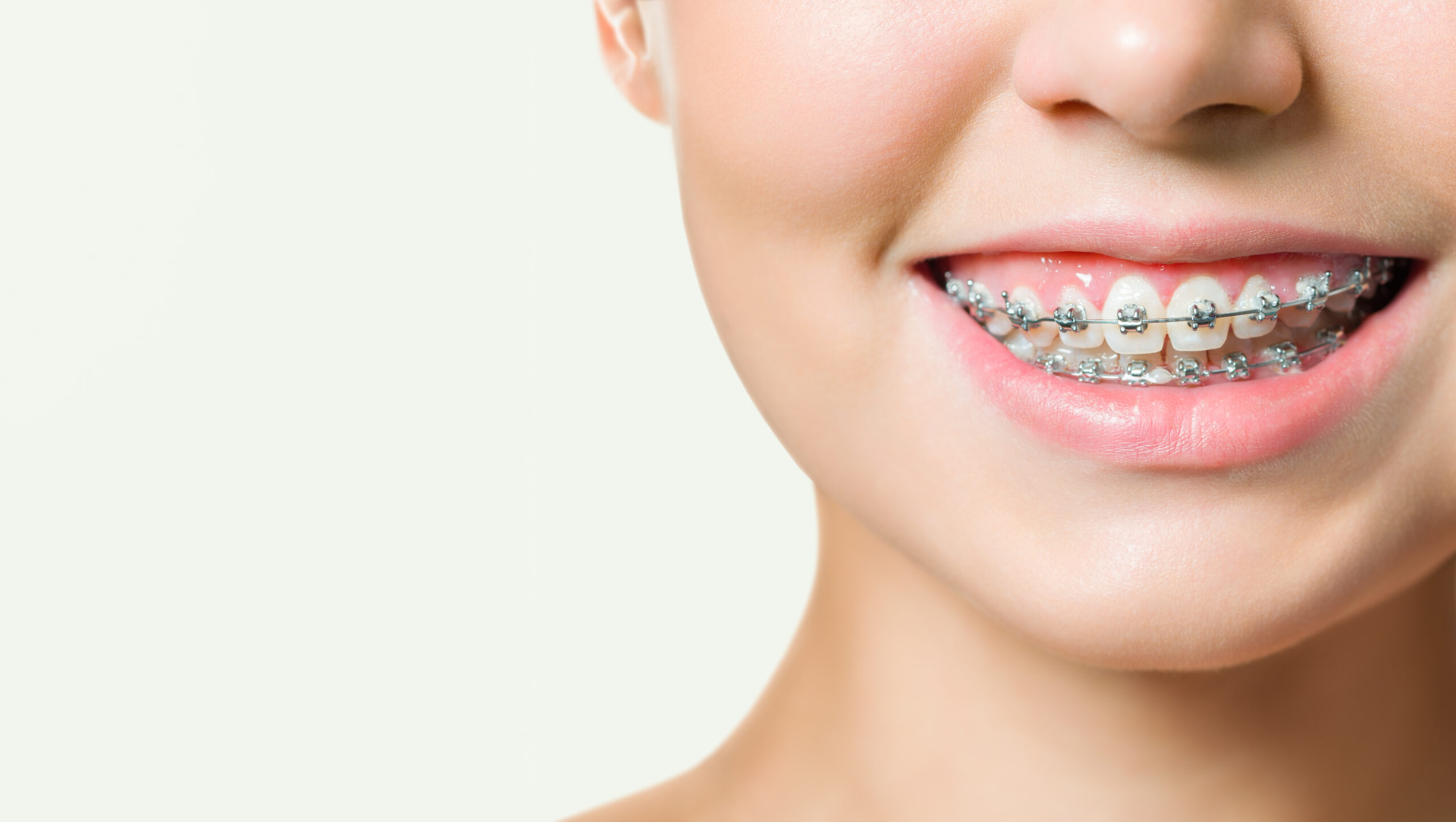 Aparat ortodontyczny efekty - uśmiechająca się kobieta z aparatem ortodontycznym na zębach.